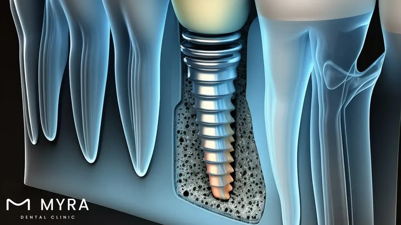 osseengtration of dental implant.webp